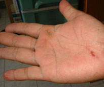 No no, this was not mine. My friend's hand - two days after the trip